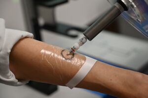 Symbolbild 3_Radioaktive Paste bei weißem Hautkrebs (c)VLKH.JPG