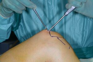 Knie_Operation_Patella_V_Rechte_Uniklinik_f_Unfallchirurgie_Innsbruck_Fotograf_Clemens_Unterwurzacher.jpg