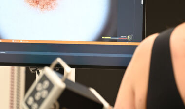 KI hilft beim Erkennen von schwarzem Hautkrebs (c)VLKH