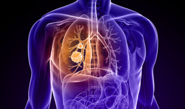 Symbolbild nicht kleinzelliger Lungenkrebs; ©SciePro_iStock
