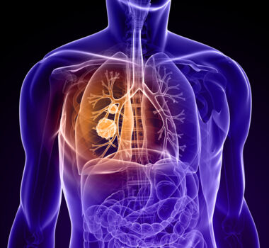 Symbolbild nicht kleinzelliger Lungenkrebs; ©SciePro_iStock