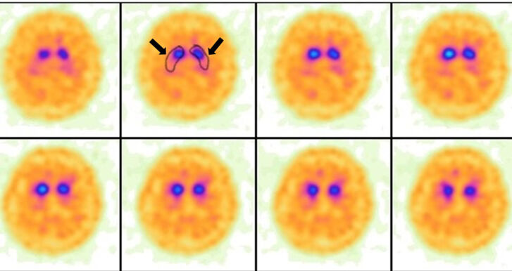 Parkinson_DATScan_pathologisch_Schnitt_©KHBG.jpg