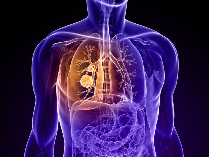 Symbolbild nicht kleinzelliger Lungenkrebs; ©SciePro_iStock.jpg