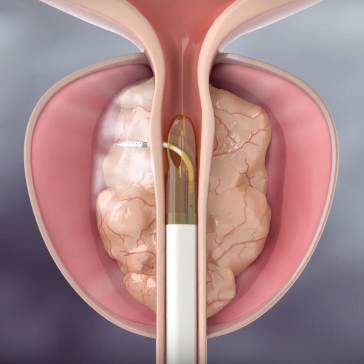 Rezum-Therapie; ©Boston Scientific.png